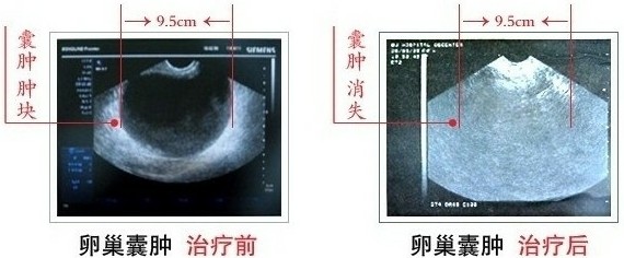 卵巢囊肿治疗前后对比图